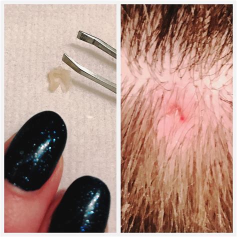 Lanced Emptied And Extracted A Pilar Cyst On My Scalp Popping
