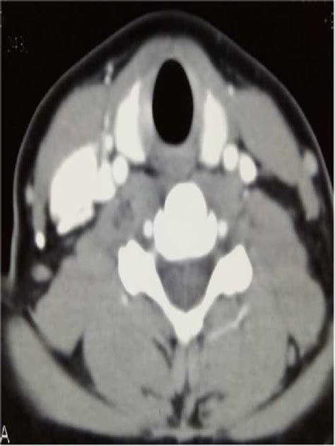 Axial Enhanced Ct Neck Showing Abnormal Enhanced Channels On Right Side