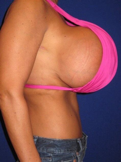 Huge Tits Cause Lower Back Pain Smoody73