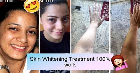 Skin Whitening Treatment 100 Work The Stylish Life