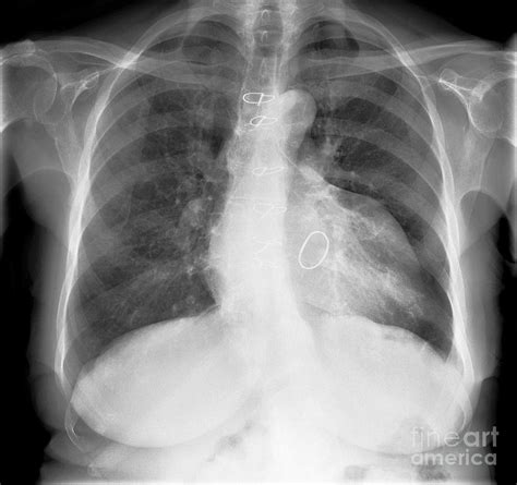 Enlarged Heart X Ray Photograph By Science Photo Library Pixels