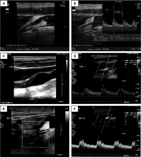 Doppler Ultrasonography Pictures Of The Right Intern Carotid Showing