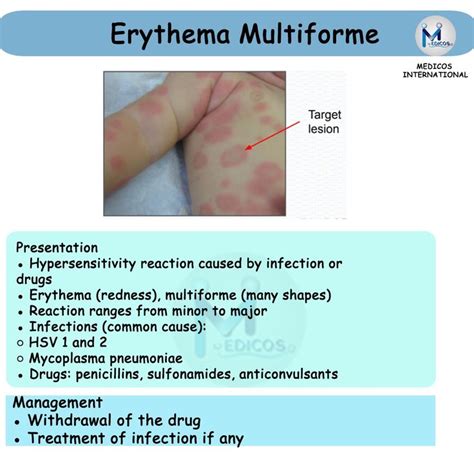Falsh Card Of Erythema Ab Igneerythema Multiforme And Fungal Infection
