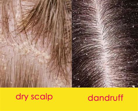 Treating Dandruff Pelo Hairdressing