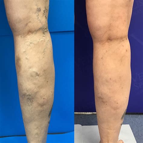 Causes Of Spider Veins Vein Specialists Of The Carolinas