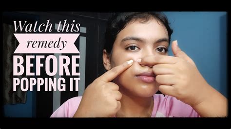 How To Get Rid Of Acne Pimple And Marks In 7 Days Simple Home Remedy