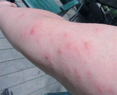 What Not To Do With Poison Ivy Rash