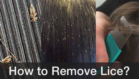 How To Get Rid Of Lice Fast And Naturally