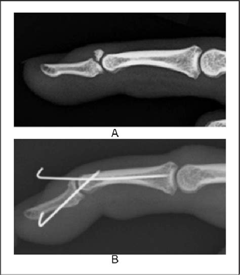 Figure 2 From Mallet Fingers With Bone Avulsion And Dip