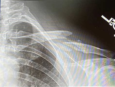 Clavicle Fracture Repair Broken Collarbone Orthopedic Shoulder