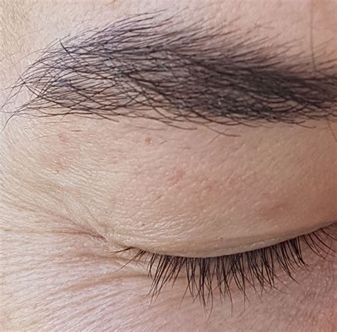 However, many clients want to have theirs removed if they are in an awkward location or for other cosmetic reasons. Gallery | Immediate Lesion Removals | Lambrobe SA