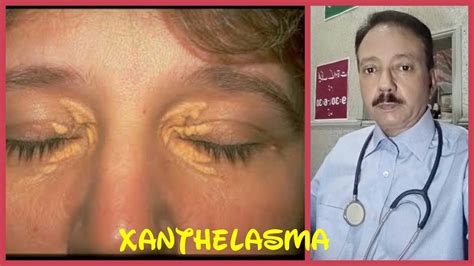 Xanthelasma Treatment Hindi I Fatty Deposits Under Eyes I Xanthelasma