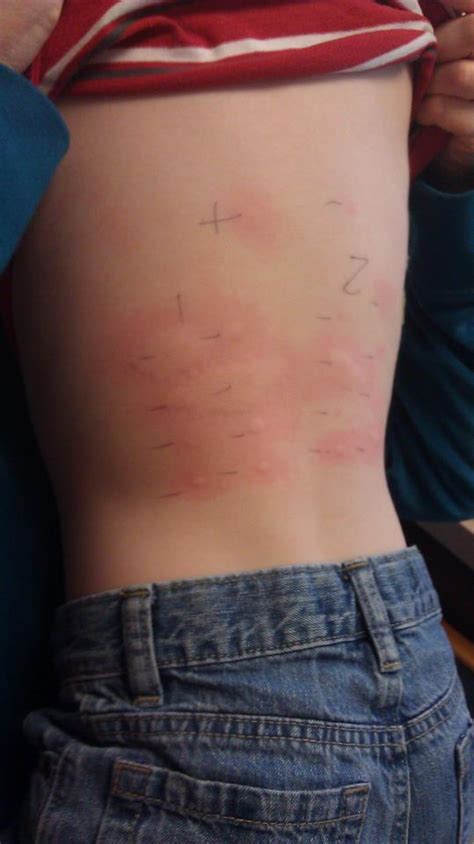 Allergic Reactions Kids With Food Allergies