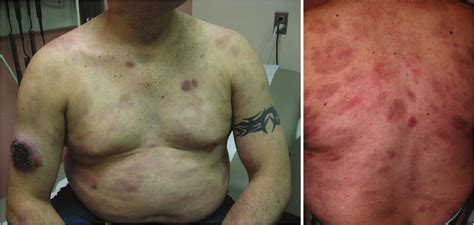 Diffuse Erythematous Violaceous Rashes Were Presented On Back Chest