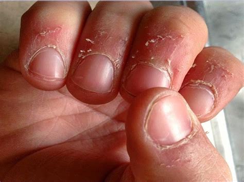 Que son los padrastros de las uñas causas y tratamientos naturales Mujer Plus