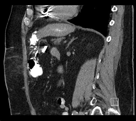 Buried Bumper Syndrome Gastrostomy Tube Radiopaedia 63843 72577