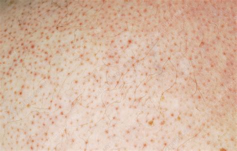 Pneumococcal Meningitis Rash Stock Image C0365855 Science Photo