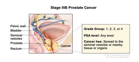 Prostate Cancer Vanderbilt Ingram Cancer Center