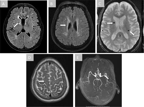 Incidental Findings On Brain Mri Arrows Indicate The Abnormalities In