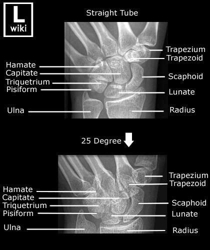 Scaphoid Radiographic Anatomy Wikiradiography Radiology Student