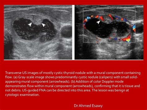 Tirads Thyroid Nodule Imaging Reporting And Data System Dr Ahmed E