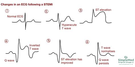 NSTEMI Vs STEMI On EKG