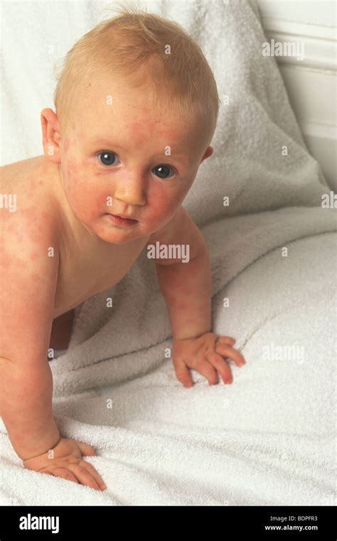 Baby With Viral Rash All Over His Body Stock Photo Alamy