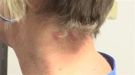 Dermatologists Seeing Increase In Gnat Attacks