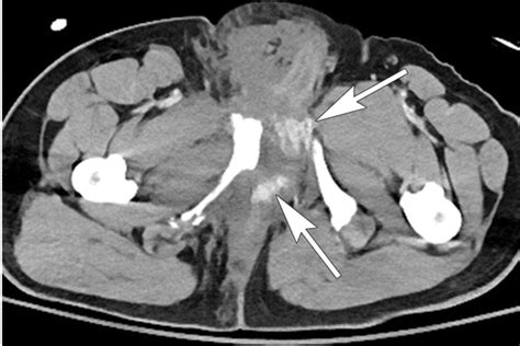 Imaging Of Acute Conditions Of The Perineum Radiographics