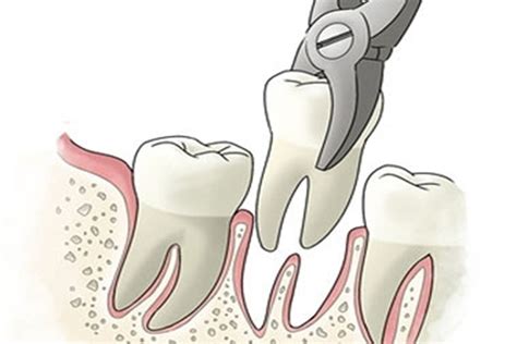 Tooth Extraction And Surgery In Indore Teeth And Braces Clinic