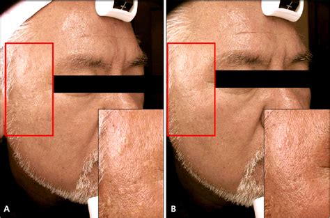 Figure From Sebaceous Hyperplasia Effectively Improved By The Pin Hole Technique With