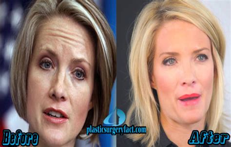Dana Perino Plastic Surgery Before And After Plastic Surgery Facts