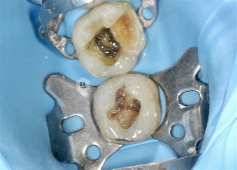 Re Operative Lower Molar Teeth Step By Step Myzerodonto