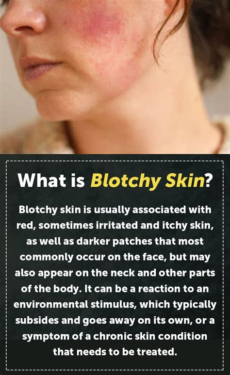 How To Solve Red Blotchy Skin Blotchy Skin Red Blotchy Skin Itchy Skin