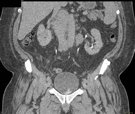 Lymphoma With Extensive Adenopathy Gastrointestinal Case Studies