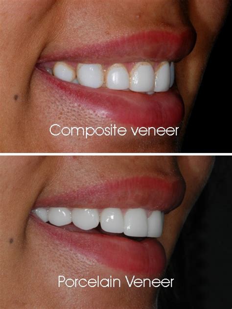 Composite Veneer