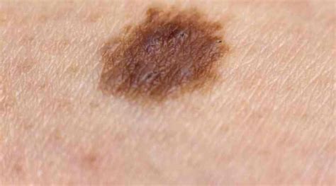 Skin Discoloration On Legs Causes Types And Treatments