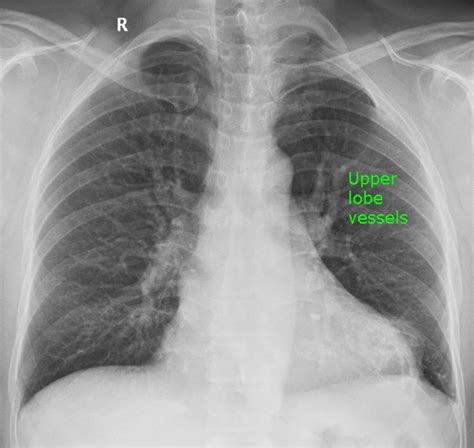 Prominent Upper Lobe Vessels On Cxr All About Cardiovascular System