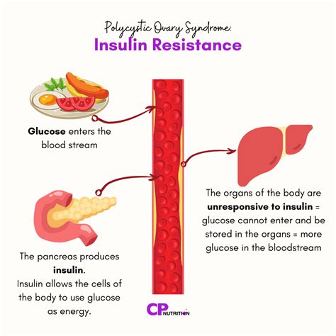 Pcos And Insulin Resistance — Claire Pettitt Cp Nutrition