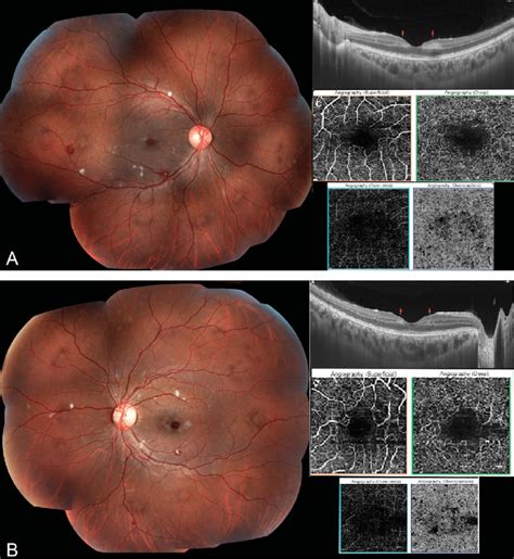A And B Fundus Photography Oct And Oct Angiography At The Time Of
