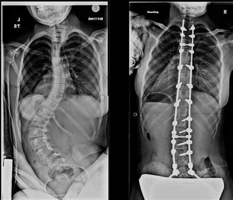 Scoliosis Johns Hopkins Medicine Health Library