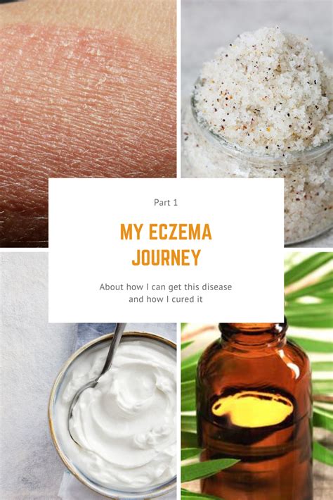 My Eczema Journey