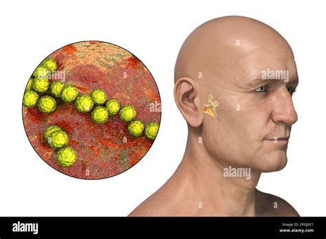Otitis Media Infección Del Oído Causada Por La Bacteria Streptococcus