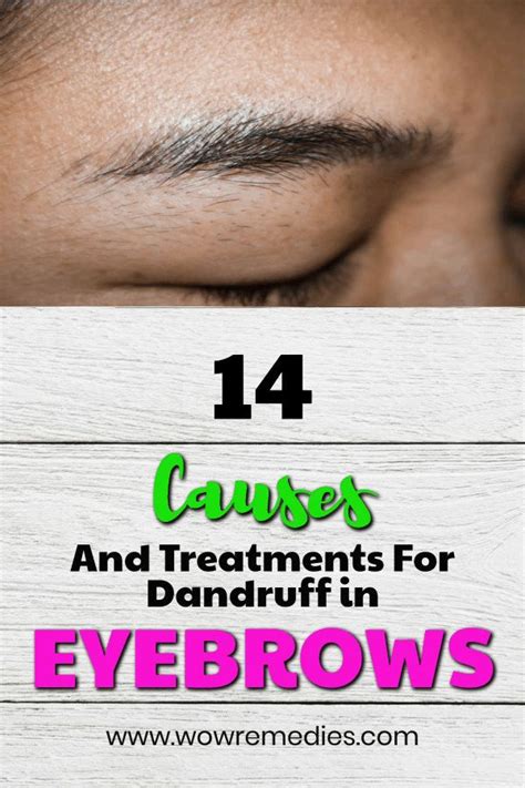 Eyebrow Dandruff Causes And Remedies Dandruff Causes Eyebrow