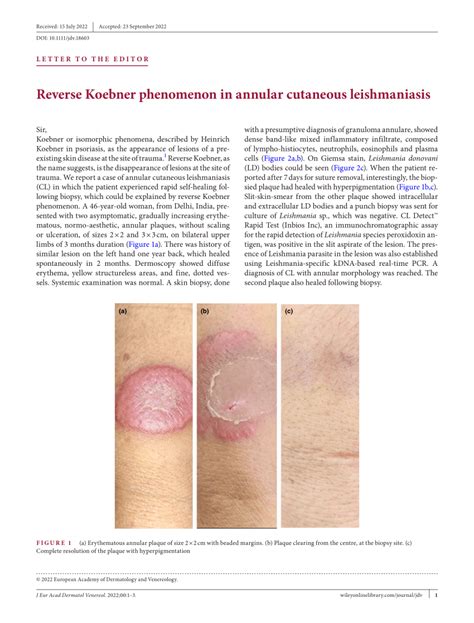 Pdf Reverse Koebner Phenomenon In Annular Cutaneous Leishmaniasis