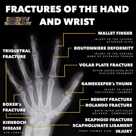 Different Types Of Hand Fractures