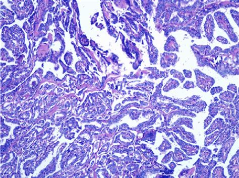 Lymph Node Metastasis By Papillary Carcinoma Thyroid Hande Stain X100