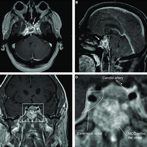 Mri Brain With Contrast Showing Merkel Cell Carcinoma Mcc