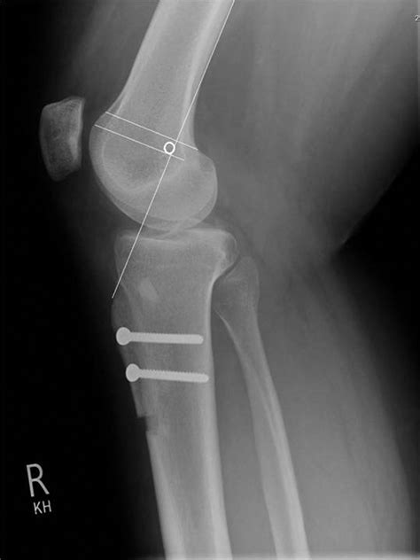 Intraoperative Localisation Of Schottles Point Without Fluoroscopy