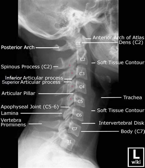 Fluoroscopic Guided Cervical Medial Branch Radiofrequency Ablation